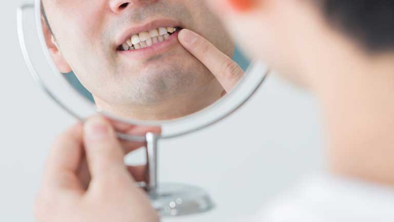 虫歯や歯周病が原因に？！歯をボロボロにする５つの悪習慣
